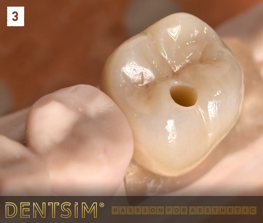 Implant dentar premium Bredent