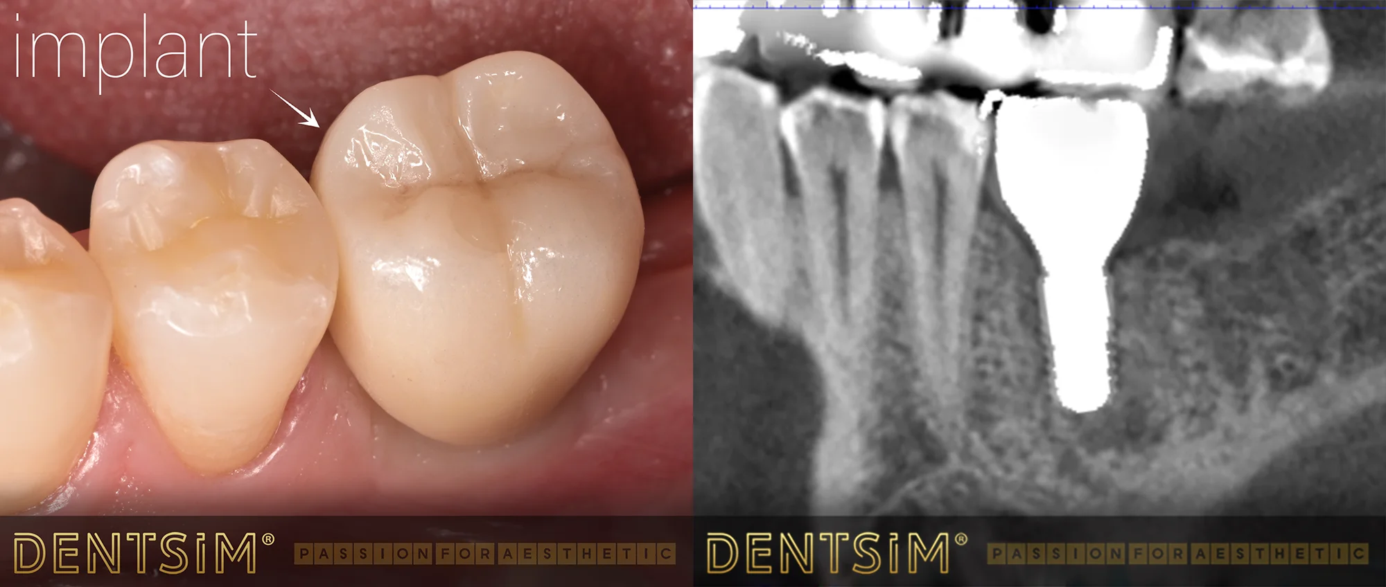 Implant dentar premium Bredent